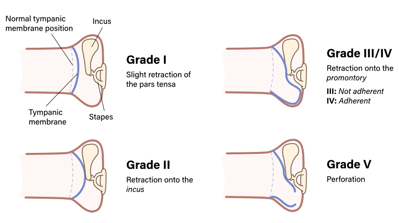 sad-classification-of-pars-tensa-retraction